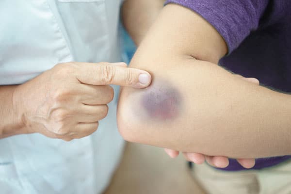 Where Did That Bruise Come From? | Summit Healthcare Medical Center